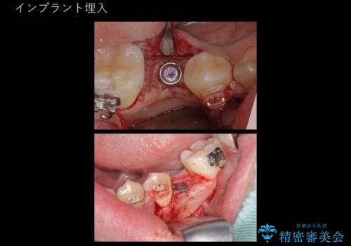 生まれつき歯が少ない 20代でインプラント治療の治療中
