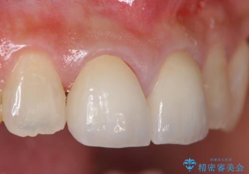 前歯をきれいにしたいの治療後