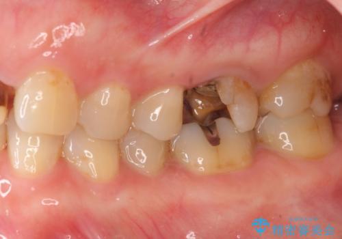 口腔内をメタルフリーにしたいの治療前
