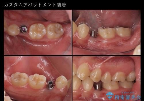 生まれつき歯が少ない 20代でインプラント治療の治療中