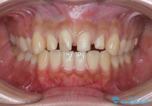 [ 前歯のセラミック治療 ]   短期間で歯並びを治したいの治療中