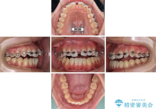 受け口と開咬を急速拡大装置とワイヤー装置で改善の治療中