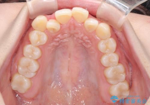 【モニター】八重歯とデコボコをスッキリきれいに ワイヤー装置での抜歯矯正の治療前