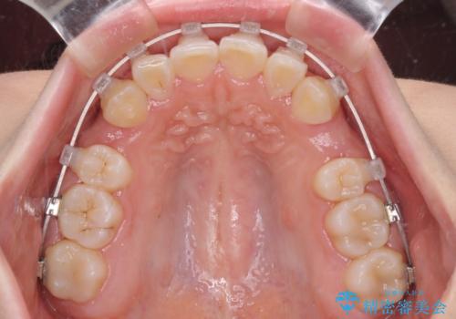 【モニター】八重歯とデコボコをスッキリきれいに ワイヤー装置での抜歯矯正の治療中
