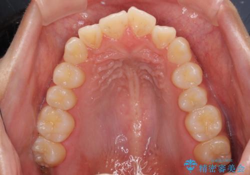受け口と開咬を急速拡大装置とワイヤー装置で改善の治療前