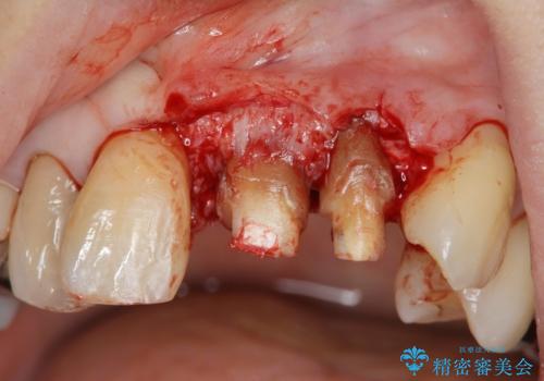 前歯をきれいにしたいの治療中