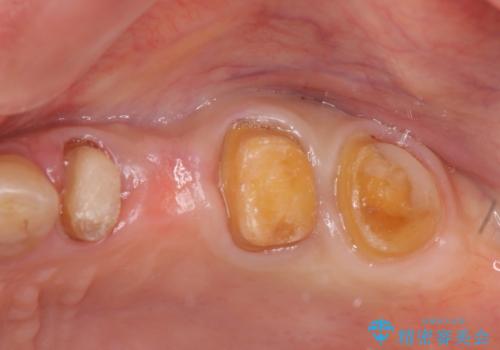 古くなった銀歯をやりかえたいの治療中