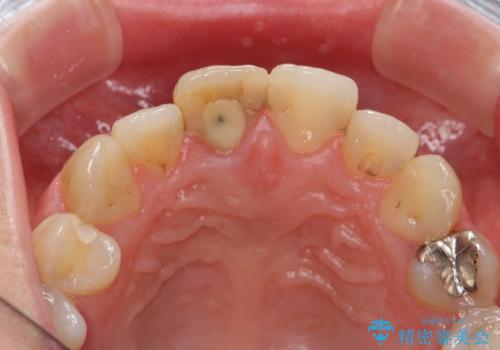 前歯をきれいにしたいの治療前