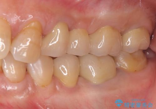 古くなった銀歯をやりかえたい