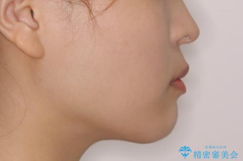 前歯で噛めない:オープンバイト(開咬)を非抜歯インビザラインで治療の治療後(顔貌)