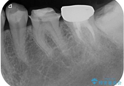 他院で仮歯までしたが、放置していたためセラミック入れたい セラミック治療の治療前