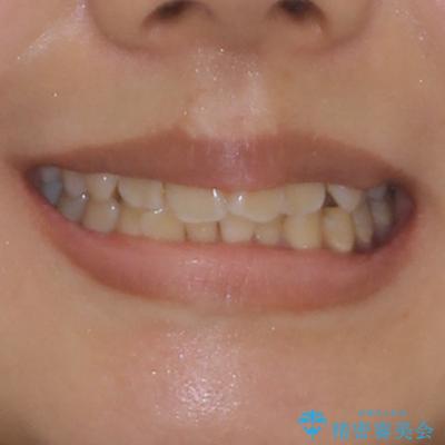 デコボコで磨きにくい前歯をスッキリと インビザライン矯正の治療前(顔貌)