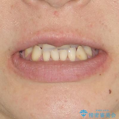 反対咬合や欠損を治療したい インビザライン矯正とオールセラミックブリッジの治療前(顔貌)