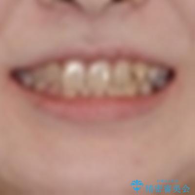 ディープバイトをインビザライン矯正で改善の治療前(顔貌)