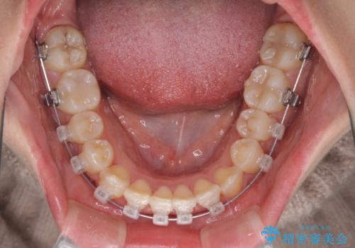 【モニター】八重歯とデコボコをスッキリきれいに　ワイヤー装置での抜歯矯正の治療中