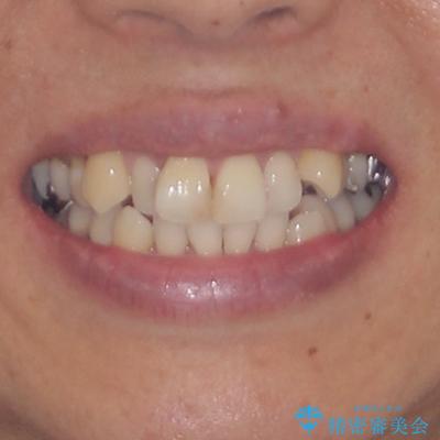 八重歯で口元が膨れている　ワイヤー装置での抜歯矯正の治療前（顔貌）