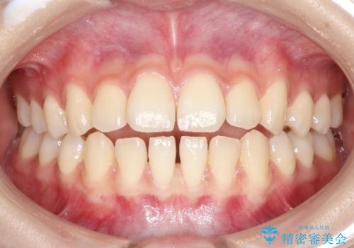 【前歯で噛めません、すきっ歯も気になります】インビザライン治療症例の症例 治療前