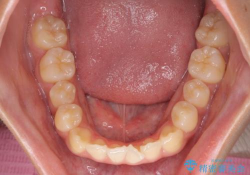受け口と開咬を急速拡大装置とワイヤー装置で改善の治療前