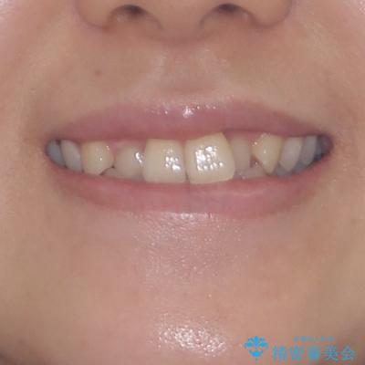前歯のクロスバイトを短期間で解消　目立たないワイヤー矯正の治療前（顔貌）