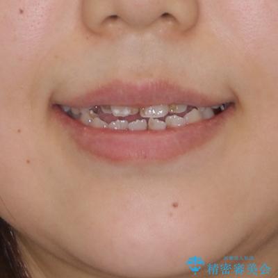 八重歯と開咬を治したい 目立たないハーフリンガル矯正の治療前(顔貌)