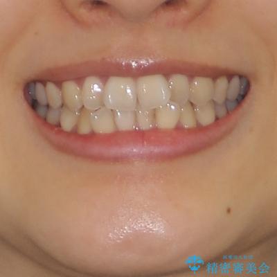 前歯のクロスバイト　ワイヤー装置を併用したインビザライン矯正の治療前（顔貌）