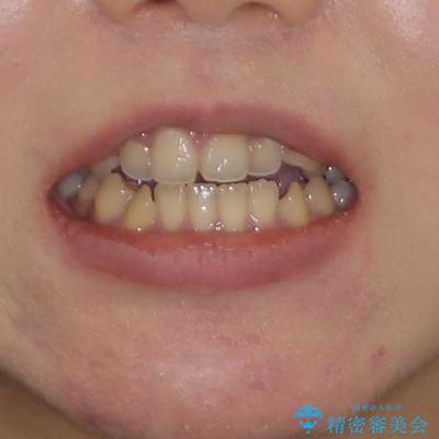 八重歯を抜歯矯正でスッキリと　メタルブラケットでの矯正治療の治療前（顔貌）