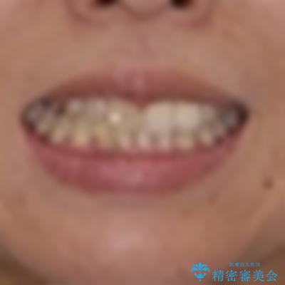 前歯のインプラント治療　折角なので矯正治療できれいな歯並びにの治療前（顔貌）