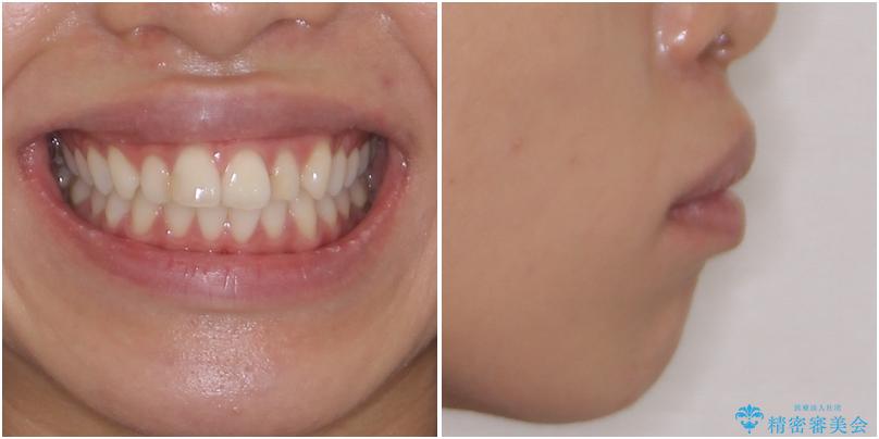 唇を閉じやすく　出っ歯の抜歯矯正の治療前（顔貌）