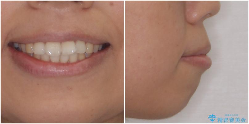 前歯の出っ歯と口の閉じにくさが気になる　目立たないワイヤー装置での抜歯矯正の治療前（顔貌）