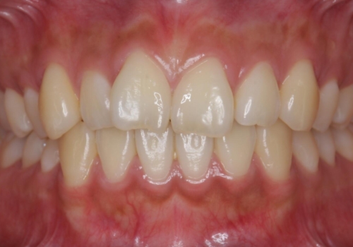 [ 前歯のセラミック治療 ]   短期間で歯並びを治したいの治療前