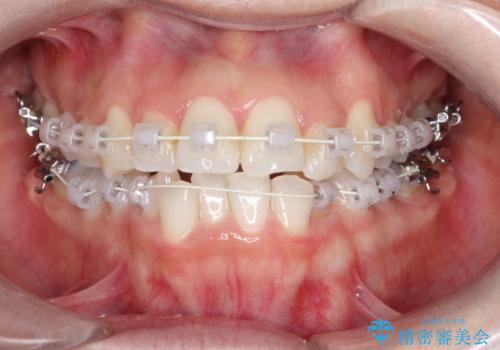 【ワイヤー矯正】前歯の凸凹を非抜歯で治療の治療中