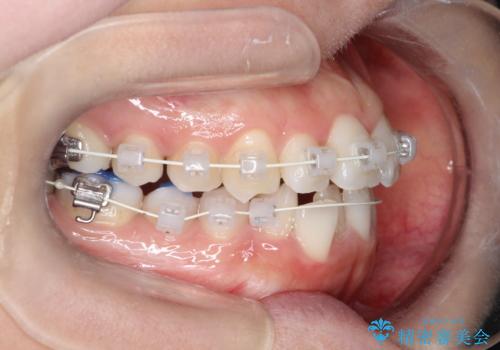 【ワイヤー矯正】前歯の凸凹を非抜歯で治療の治療中
