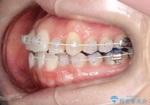 【ワイヤー矯正】前歯の凸凹を非抜歯で治療の治療中