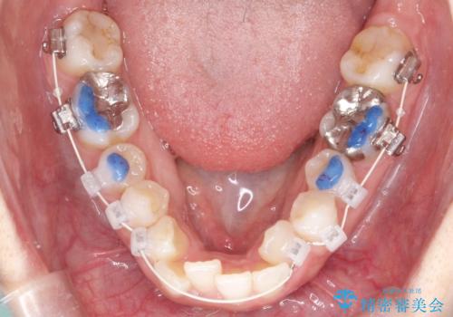 【ワイヤー矯正】前歯の凸凹を非抜歯で治療の治療中