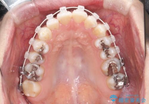 【ワイヤー矯正】前歯の凸凹を非抜歯で治療の治療中
