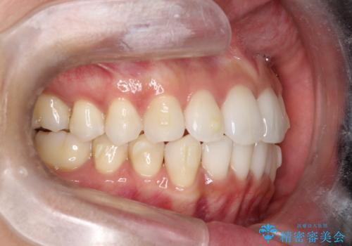 【インビザライン】前歯の凸凹をIPRで改善の治療中