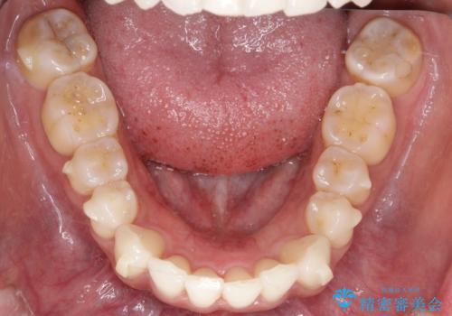 【インビザライン】前歯の凸凹をIPRで改善の治療中