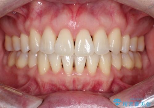【抜歯ケース】前歯のガタガタをインビザラインで治療の症例 治療後