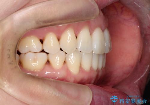 【抜歯ケース】前歯のガタガタをインビザラインで治療の治療後