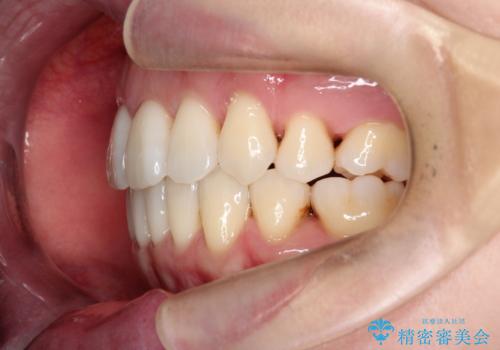 【抜歯ケース】前歯のガタガタをインビザラインで治療の治療後