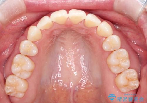 【抜歯ケース】前歯のガタガタをインビザラインで治療の治療後