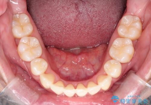 【抜歯ケース】前歯のガタガタをインビザラインで治療の治療後