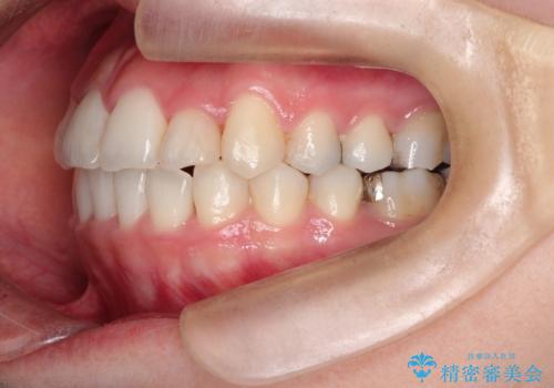 【ワイヤー矯正】前歯の凸凹を非抜歯で治療の治療後