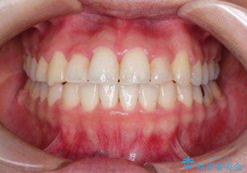 【ワイヤー矯正】前歯の凸凹を非抜歯で治療の治療後