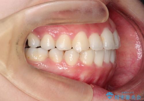 【ワイヤー矯正】前歯の凸凹を非抜歯で治療の治療後