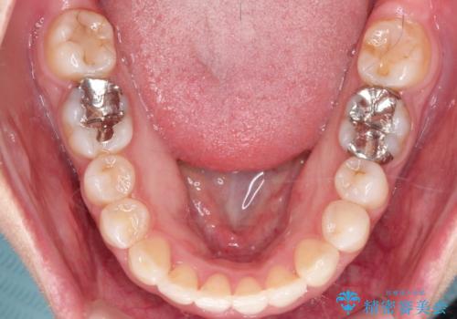 【ワイヤー矯正】前歯の凸凹を非抜歯で治療の治療後