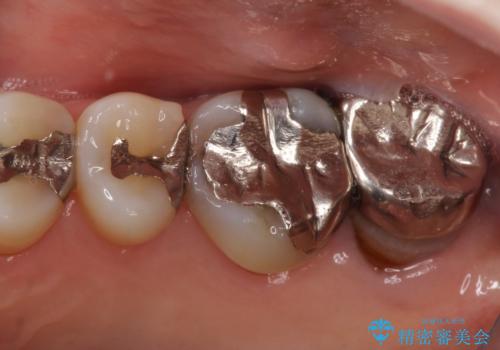 【根管治療】未処置根管を有した歯の再根管治療の症例 治療前