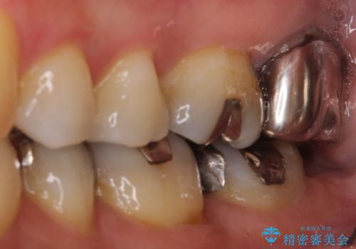 【根管治療】未処置根管を有した歯の再根管治療の治療前