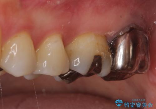 【根管治療】未処置根管を有した歯の再根管治療の治療前