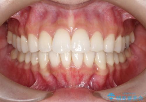 【インビザライン】前歯の凸凹をIPRで改善の症例 治療後